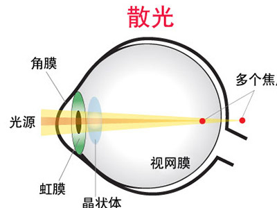 散光的眼球结构