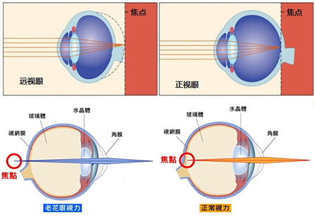 眼球的远视